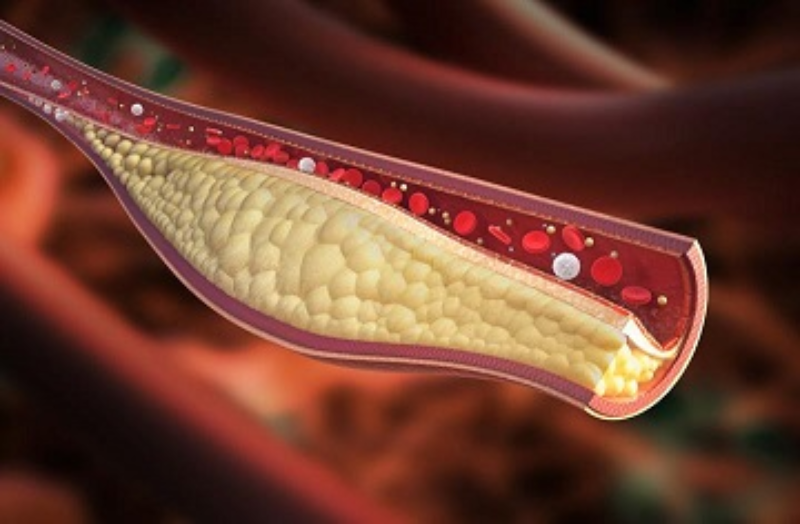 Cholesterol 